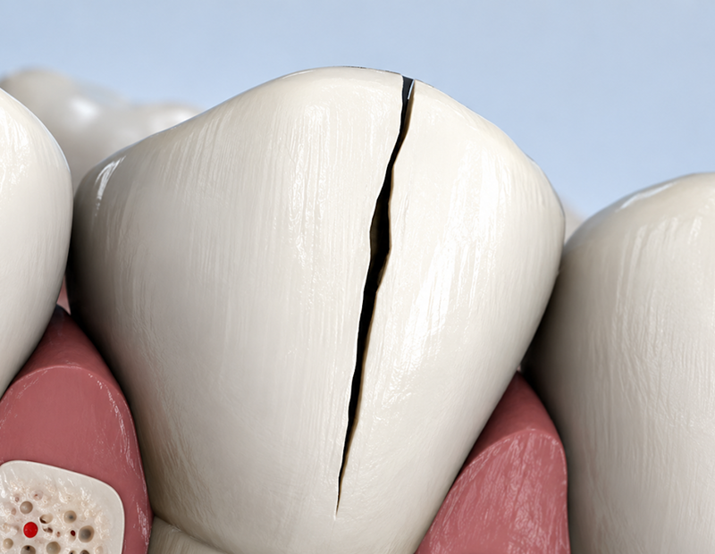 Cracked tooth illustration