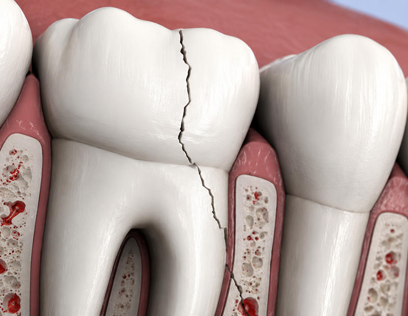 Cracked tooth illustration with root exposure