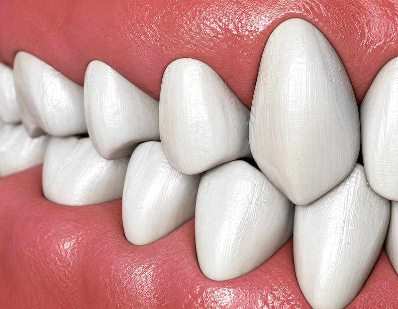 Dental underbite close-up depiction