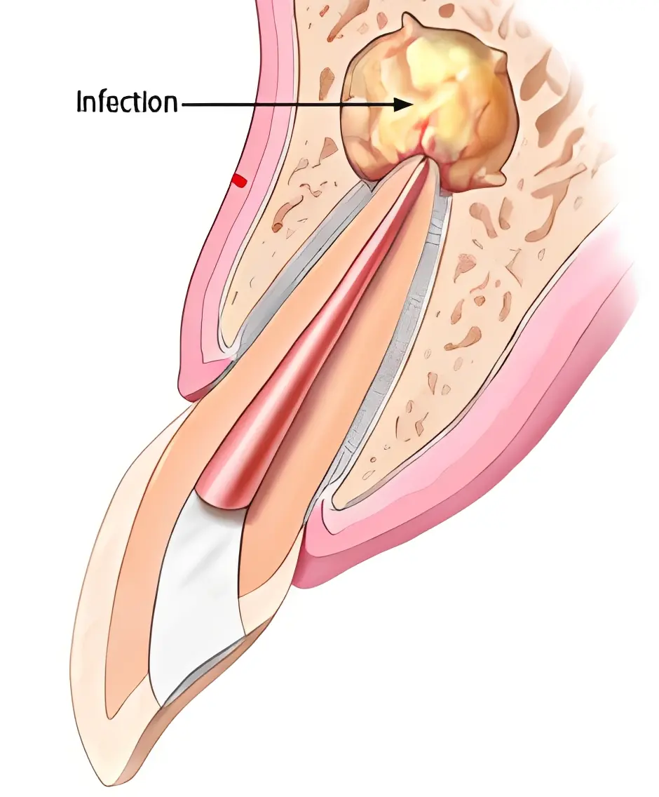 Surgical removal of infected ingrown toenail tissue