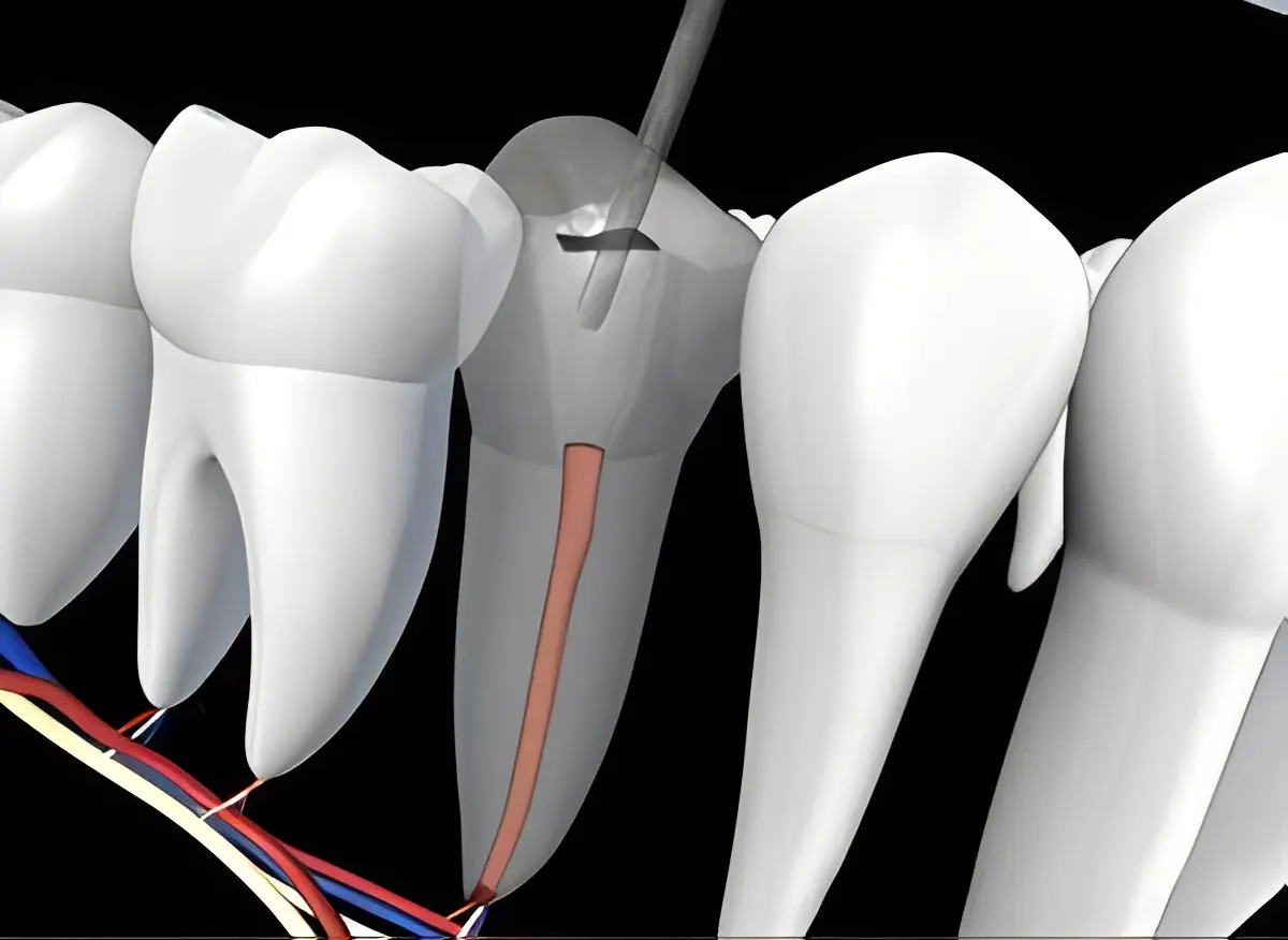 Root canal treatment on molar tooth illustration