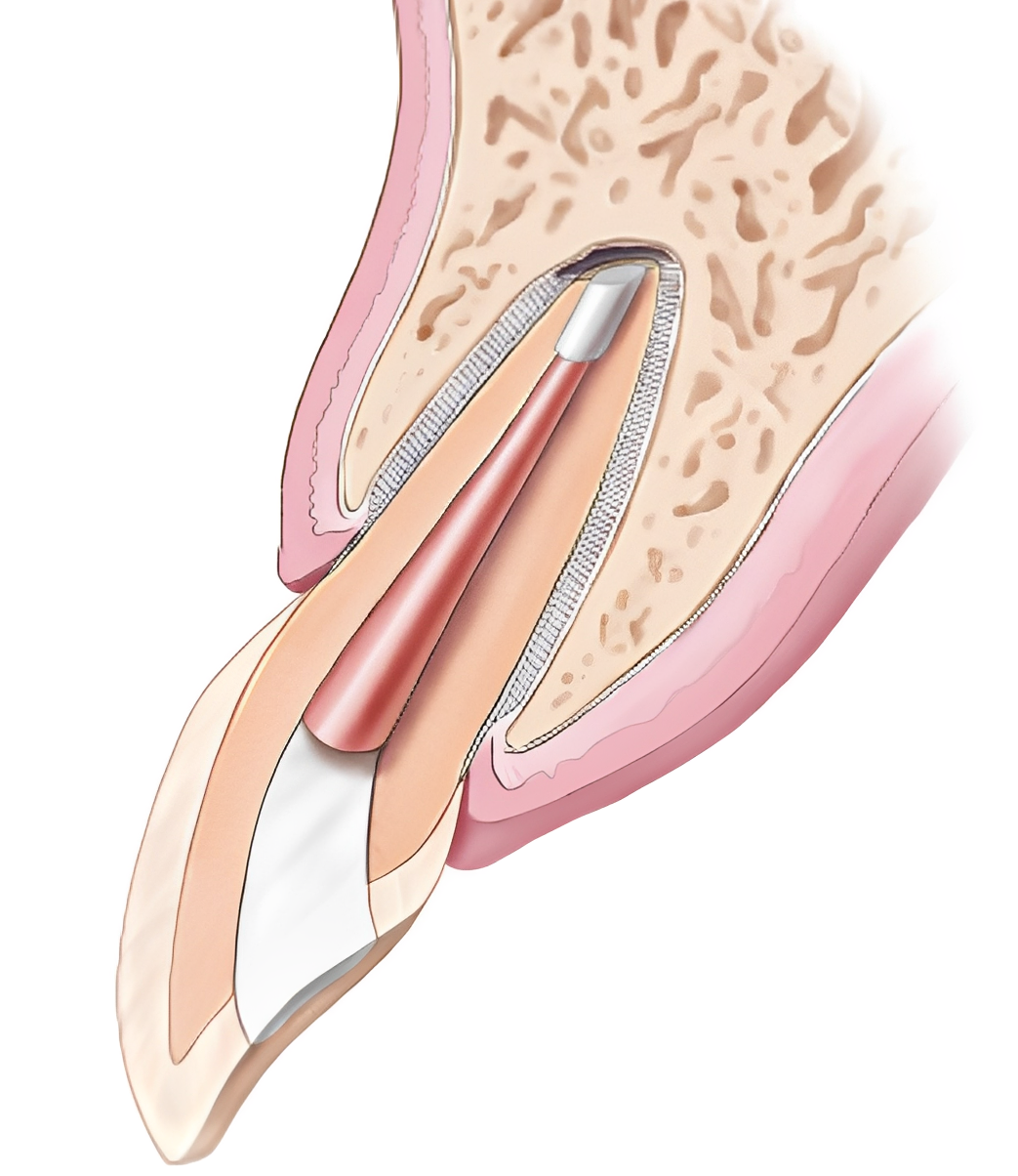 Tooth cross-section showing root canal filling