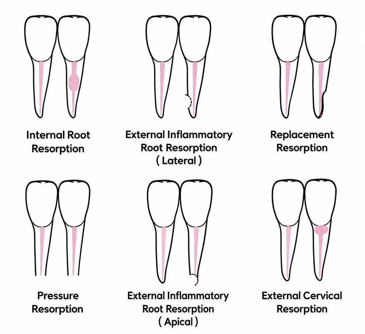 Diagram showing types of tooth root resorption.