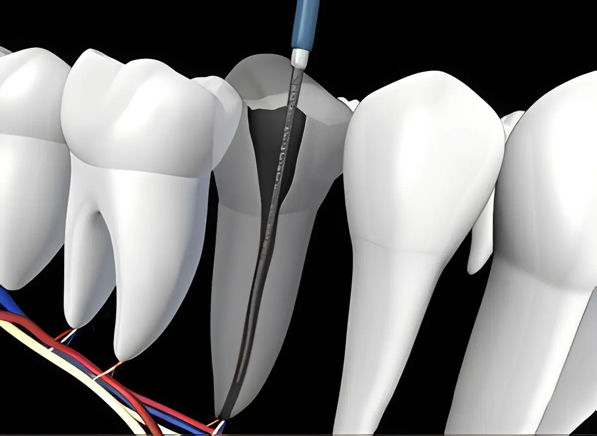 Root canal file inside molar tooth