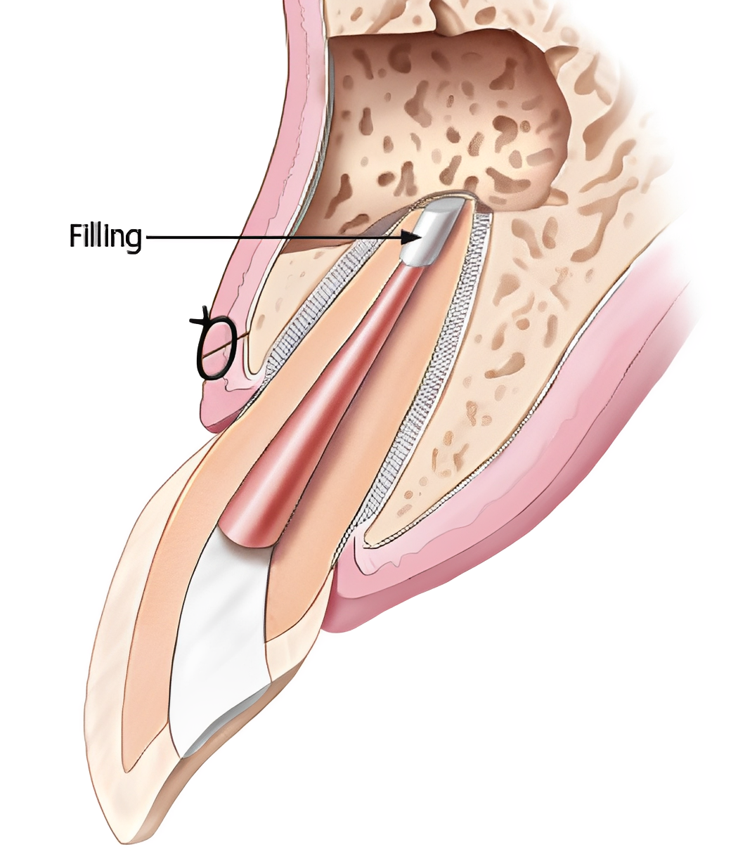 Cross-section of tooth with root canal filling