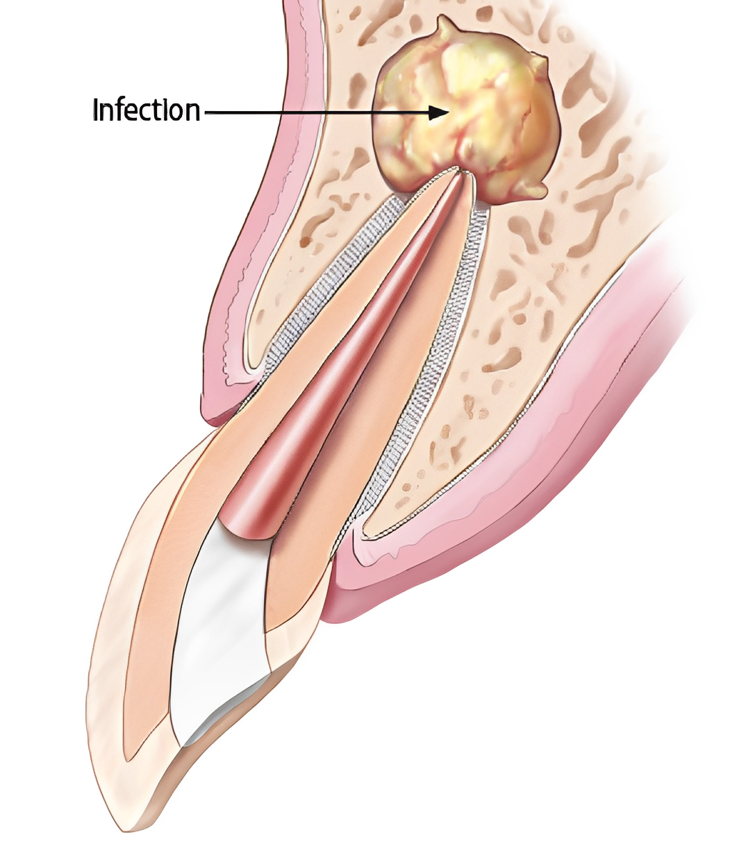 Cross-section showing periapical tooth root abscess