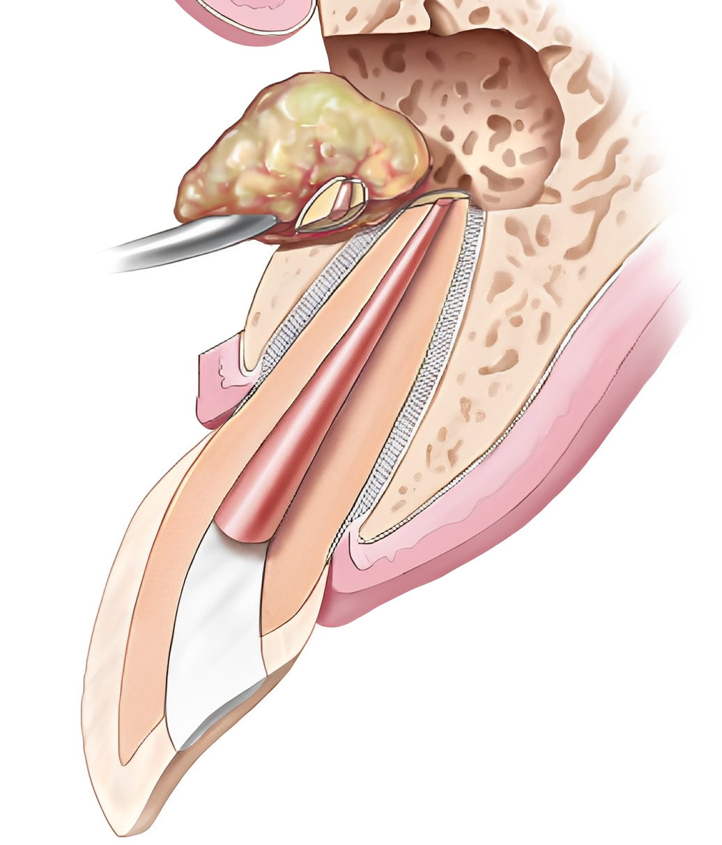 Impacted molar surgical extraction illustration