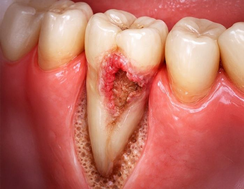 Severely decayed tooth with exposed pulp