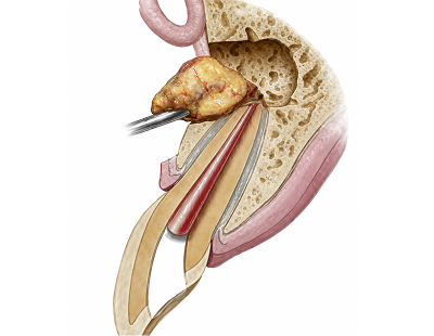 Surgical removal of middle ear cholesteatoma