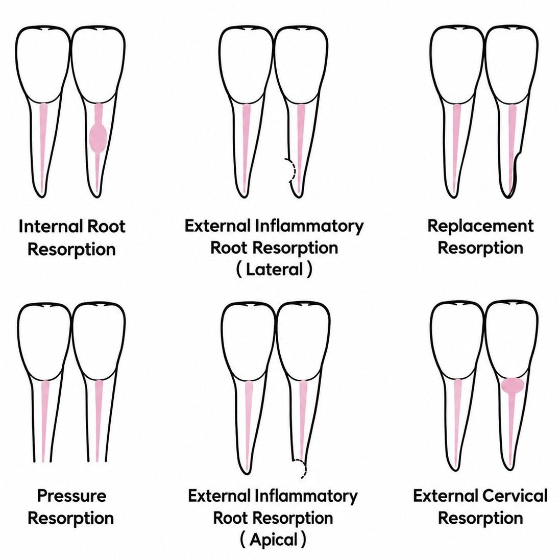 Diagram of various tooth resorption types.