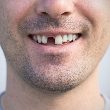Smiling man missing front tooth close-up