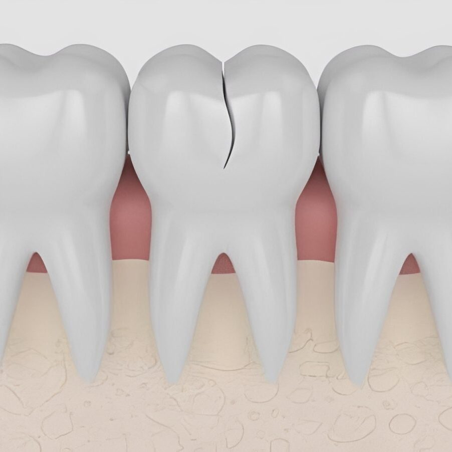Cracked molar between two healthy molars